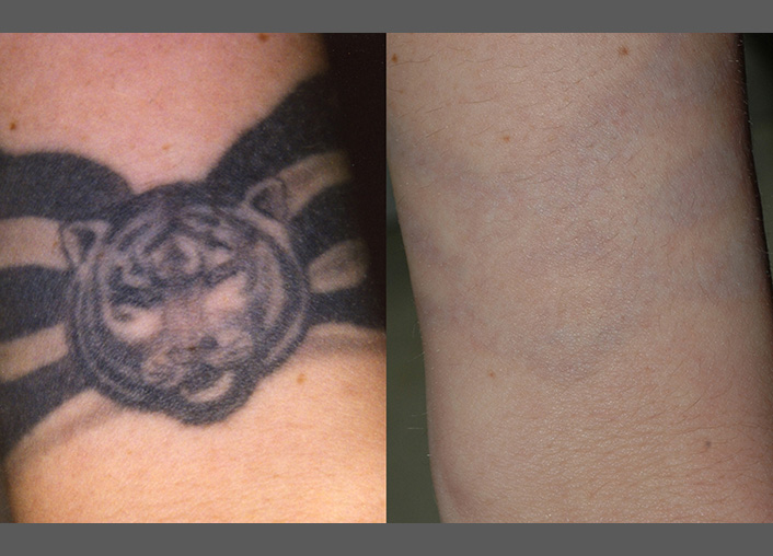  înlăturarea tatuajului cu laser fără urme 