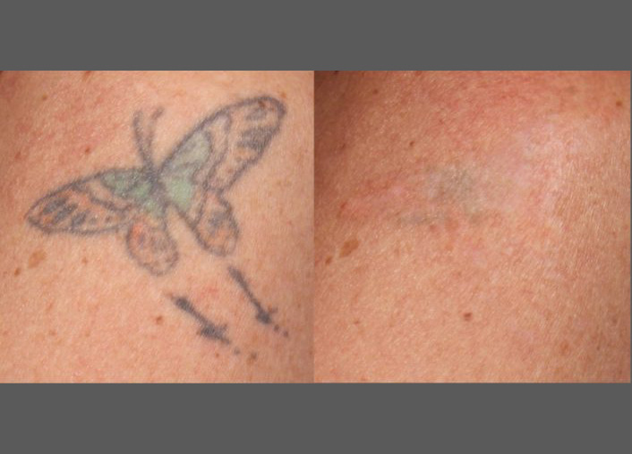  rezultatul înlăturării tatuajului cu laser după 7 proceduri