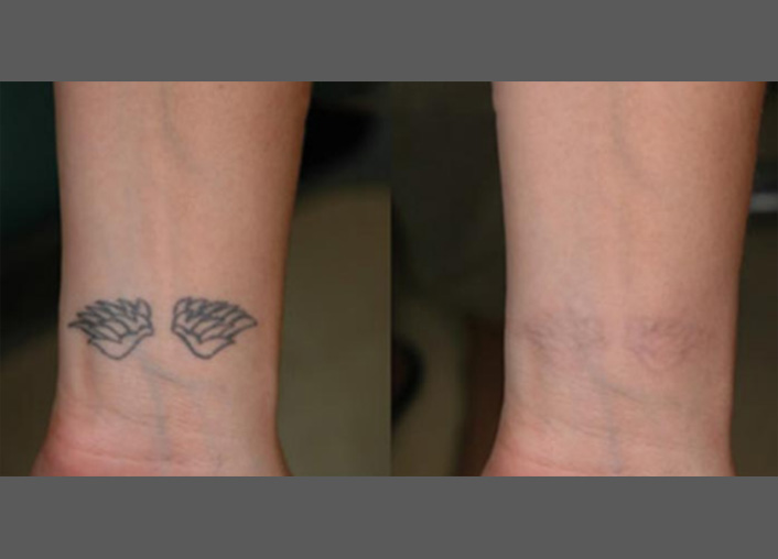  înlăturarea tatuajului cu laser rezultat